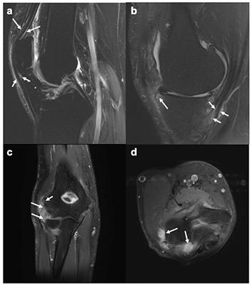 Magnetic Resonance Imaging of Enthesitis in Spondyloarthritis, Including Psoriatic Arthritis—Status and Recent Advances